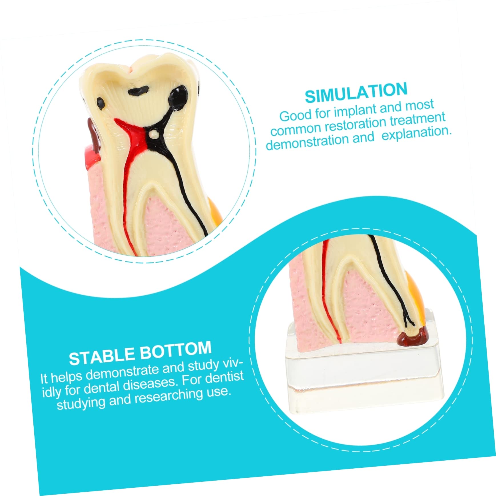 Amazon.co.jp: Mobestech 4回虫歯解剖モデル 歯の模型 教育ツール 模型